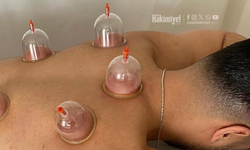 Yozgat’ta En Çok Talep Gören Yöntemler Masaya Yatırıldı: Hacamat’tan Akupunktura