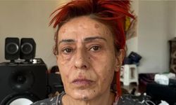 Yıldız Tilbe'nin yüzüne ne oldu? Yıldız Tilbe'nin yüzü neden yandı?