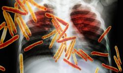 Verem Tehlikesi Sürüyor: Yozgat'tan Önemli Açıklama