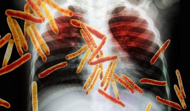 Verem Tehlikesi Sürüyor: Yozgat'tan Önemli Açıklama