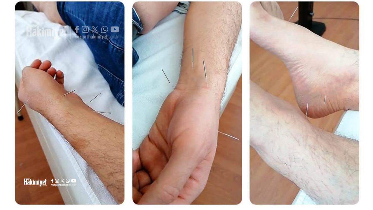 Yozgat’ta En Çok Talep Gören Yöntemler Masaya Yatırıldı Hacamat’tan Akupunktura (3)