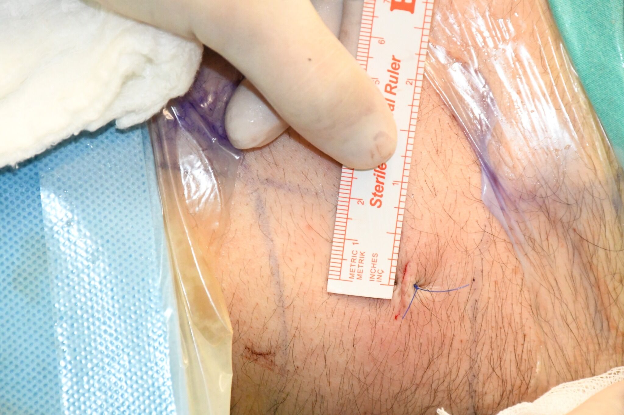 Yozgat’ta Dev Böbrek Taşı 5 Mm’lik Kesiyle Alındı1