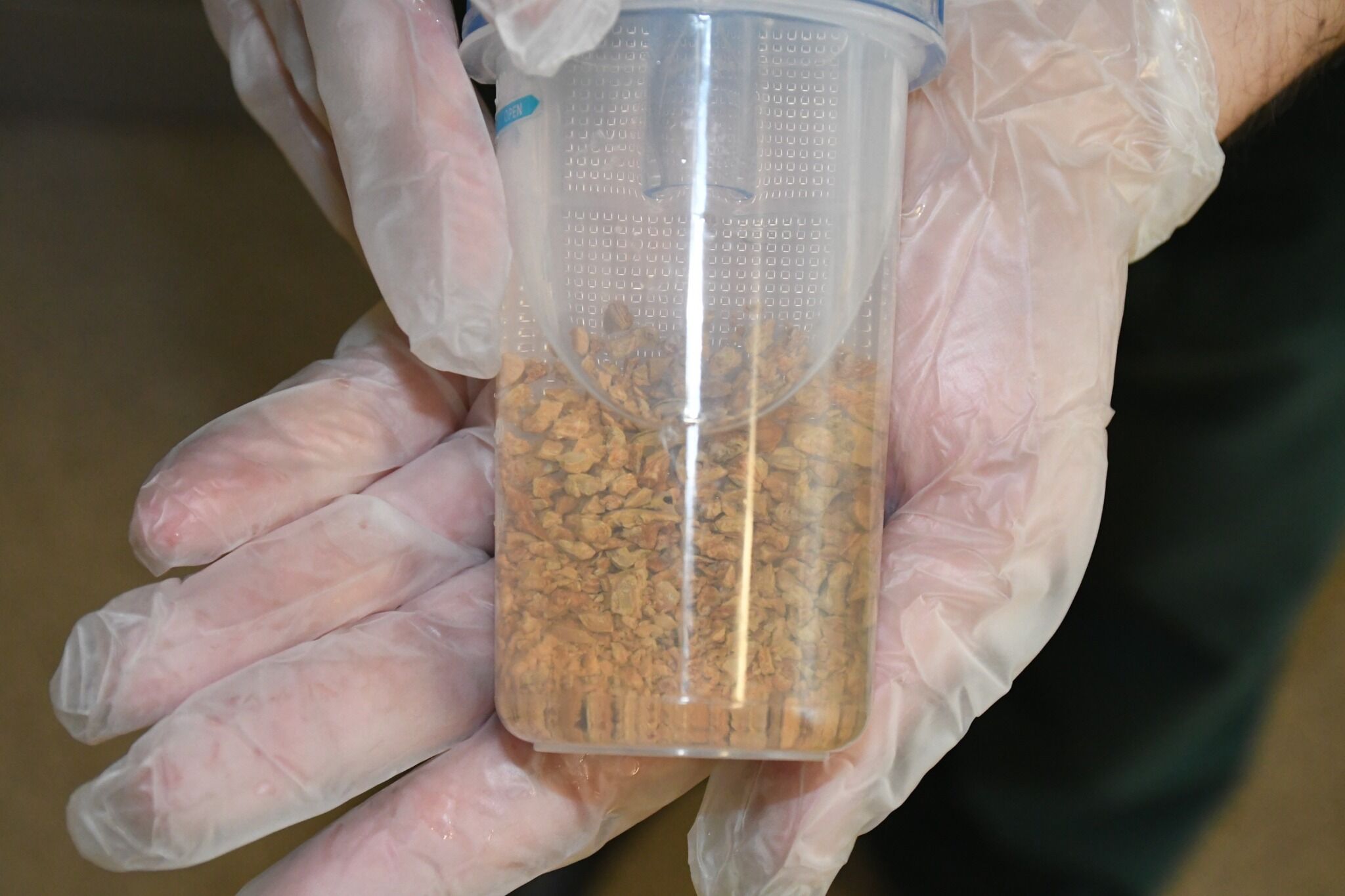 Yozgat’ta Dev Böbrek Taşı 5 Mm’lik Kesiyle Alındı2