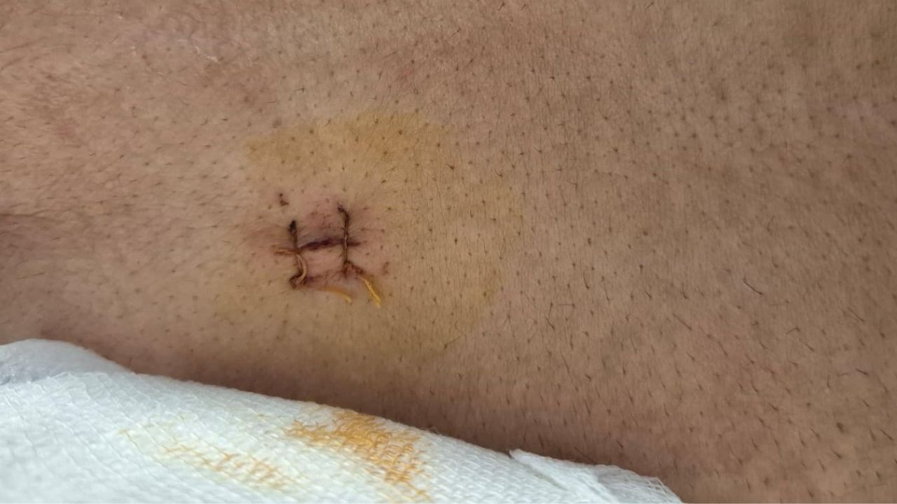 İl Dışına Gitmeye Gerek Kalmadı! Yozgat Şehir Hastanesi’nden Başarılı Operasyon (1)