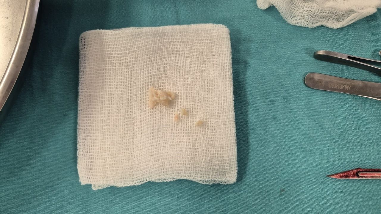 İl Dışına Gitmeye Gerek Kalmadı! Yozgat Şehir Hastanesi’nden Başarılı Operasyon (2)