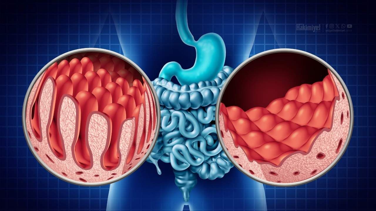 Yozgatlılar Dikkat! Sürekli Halsizlik Çölyak Habercisi Olabilir (2)