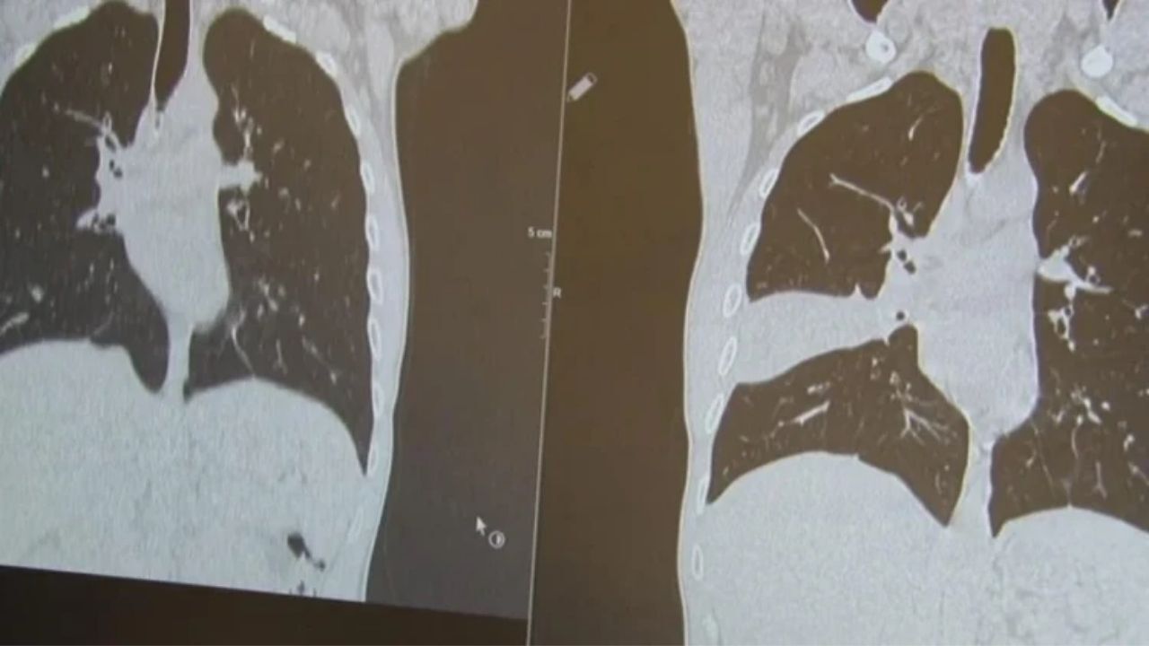 Onur Derdiyok Kimdir Akciğerdeki Kemiği Çıkaran Doktor Gündemde