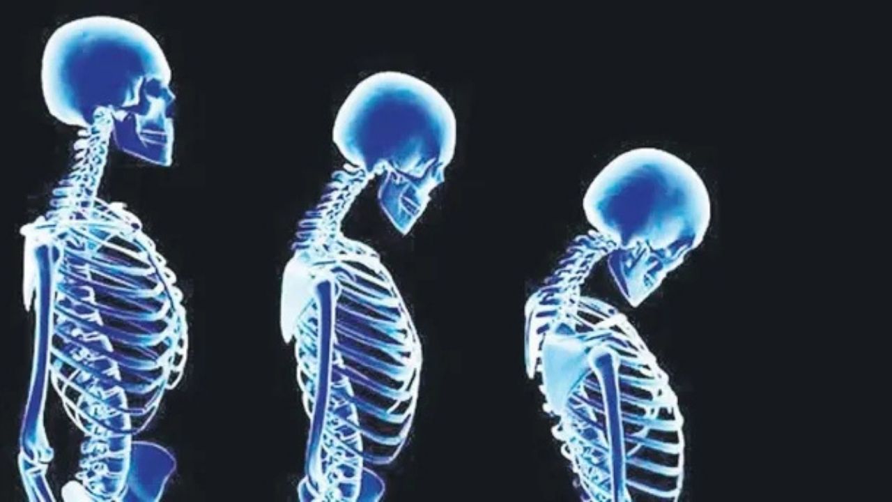 Boğazlıyan Devlet Hastanesi’nden Osteoporoz Uyarısı Kemik Sağlığınızı İhmal Etmeyin (1)