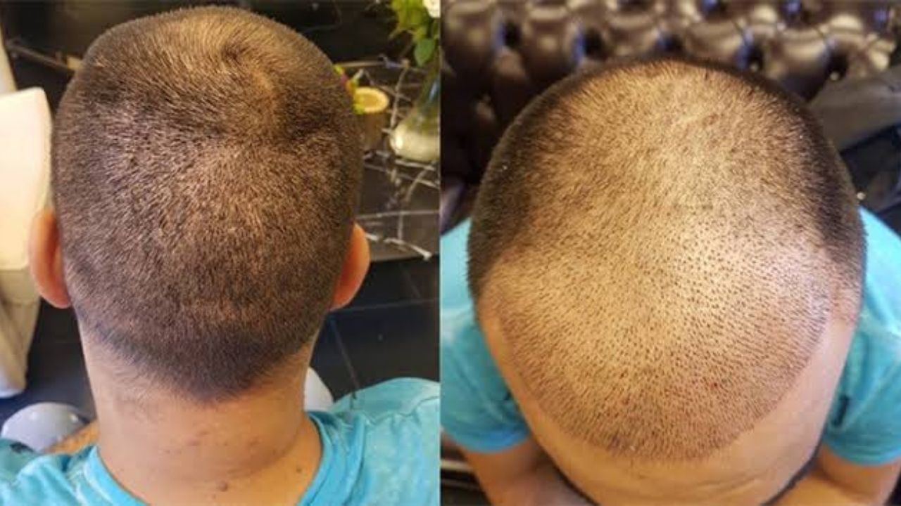 Yozgatlılar Dikkat! Uzmanından Kritik Uyarılar Saç Ekiminde Doğru Yaş Ne Zaman (1)